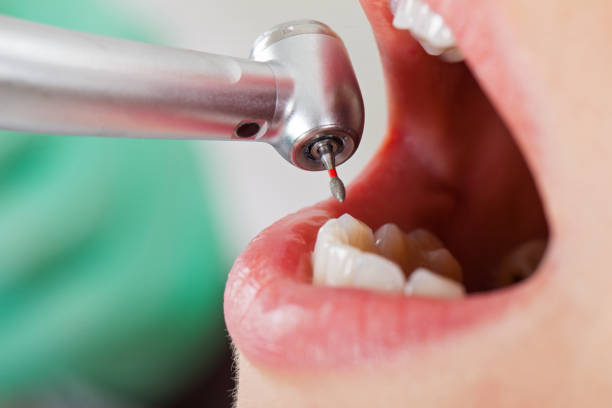 Best Emergency Treatment for Dental Infections or Abscesses in Lincoln Village, OH